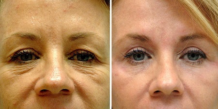 Blepharoplastie Laser Tunisie