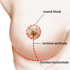 Réduction mammaire en Tunisie les incisions pratiquées
