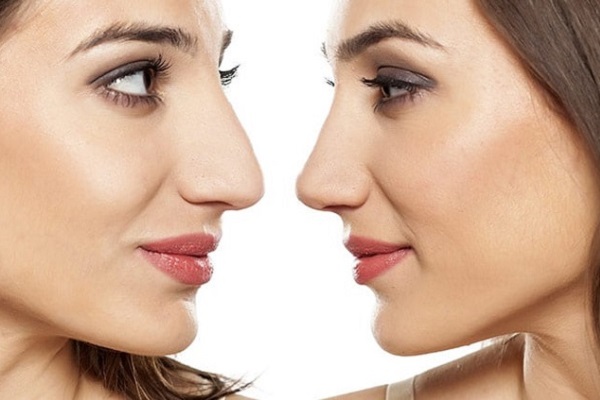 Rhinoplastie ultrasonique Tunisie